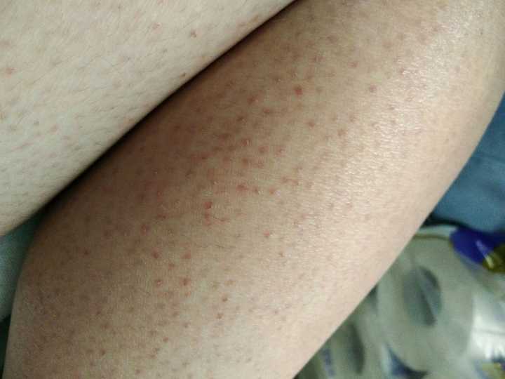 毛囊角质化(鸡皮肤)是否无法改善?