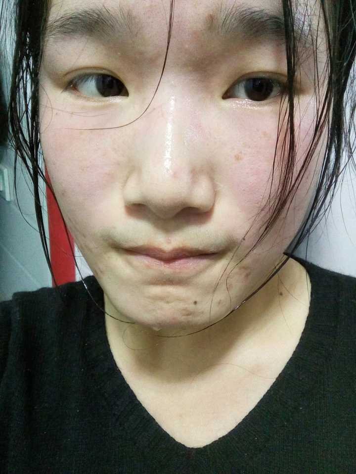 如图,下面是我烂脸的部分照片,实际应该更加严重我实在没勇气放.