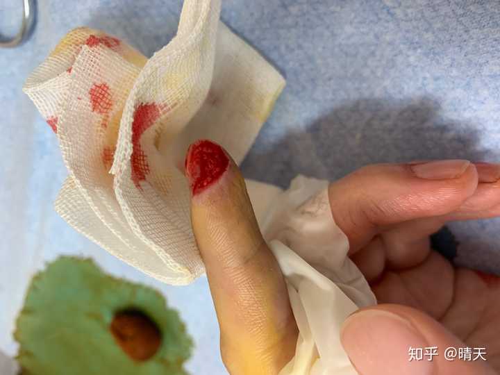 手指被割掉一块肉是什么体验