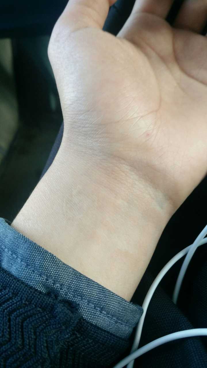 女生手臂内侧有牛奶咖啡斑(胎记)长的清秀 挺漂亮的