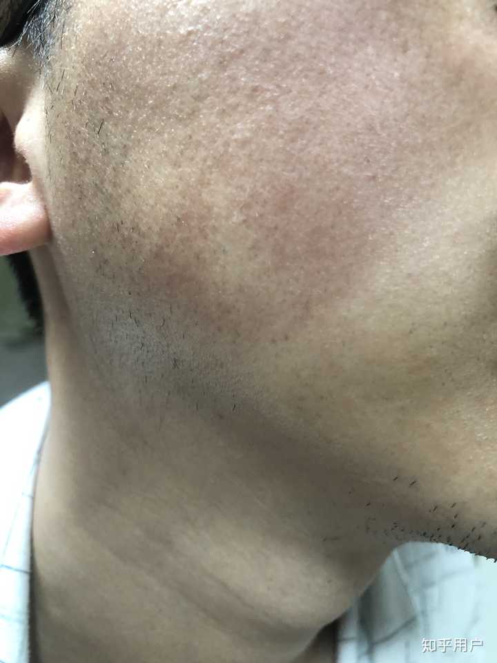 脸部毛周角化症怎么破?