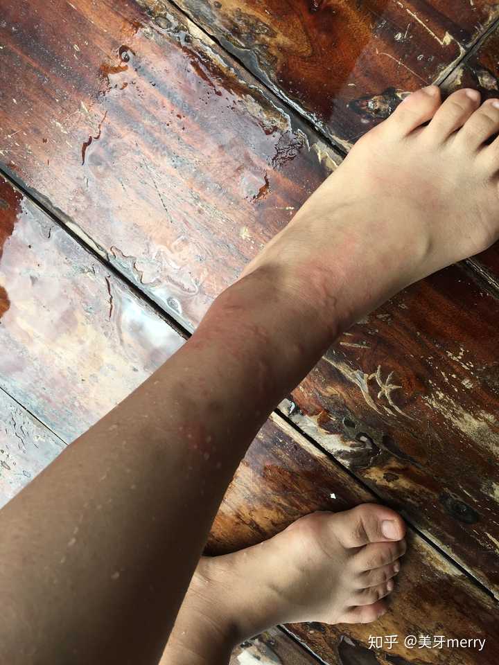 被水母蛰是一种什么体验?