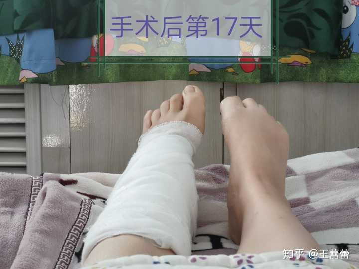 术后17天抓脚趾角度和右脚比差好远