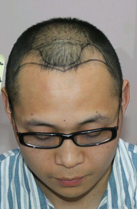 当然,您也可以考虑通过植发来改善发际线后移的问题.