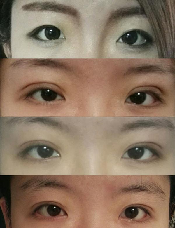 第一张是埋线双眼皮之前贴的内双   有美瞳有妆   以下分别是埋线