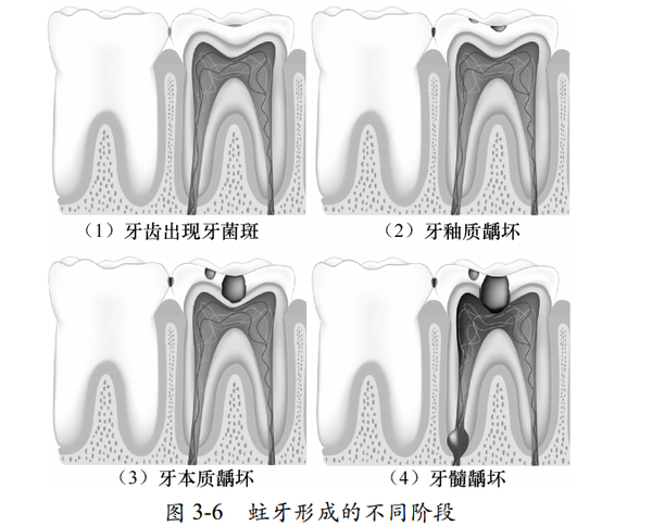 蛀牙是如何形成的
