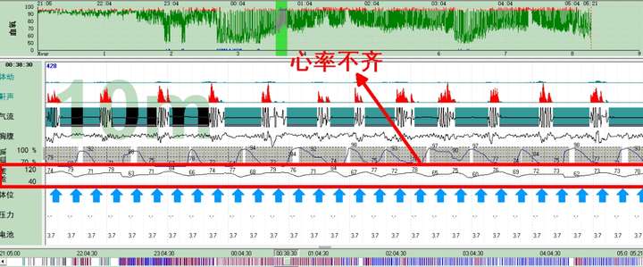 如何从脉搏波波形判断呼吸暂停情况?