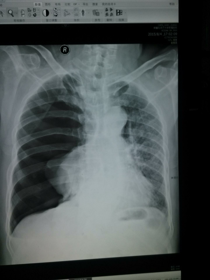 气胸与肺不张如何用影像学鉴别?