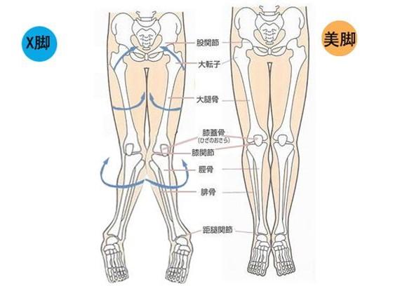 膝外翻x型腿需要治疗康复么有什么后果