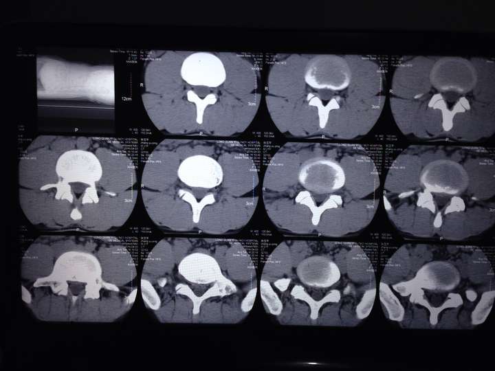 5cm,压迫硬膜囊,现在已经针灸半个月,左腿和屁股好痛啊,弯腰的时候痛