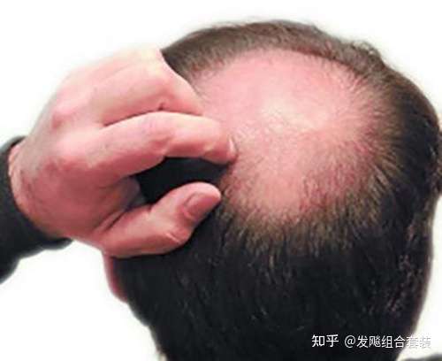 头顶脱发,以前没在意过,现在看着越来越严重了没么办啊?