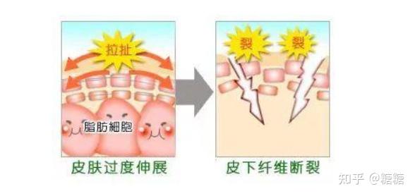 皮肤会被不断的拉扯,导致真皮层结缔组织受损,胶原纤维和弹力纤维断裂