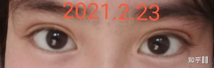 由于戴眼镜,我的眼睛已经明显变形