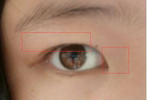 照片看,内眦赘皮严重,内双,眼尾处脂肪多,可以通过双眼皮 开内眼角来