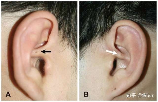 先天性耳前瘘管的小洞洞大多数在耳前,只有个别人开口于耳轮靠后上