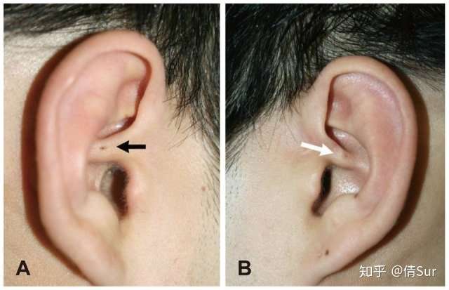 net,侵权删除!不同部位的耳前瘘管