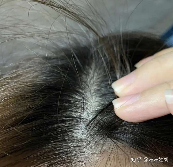 附着在头皮上的大块头皮屑