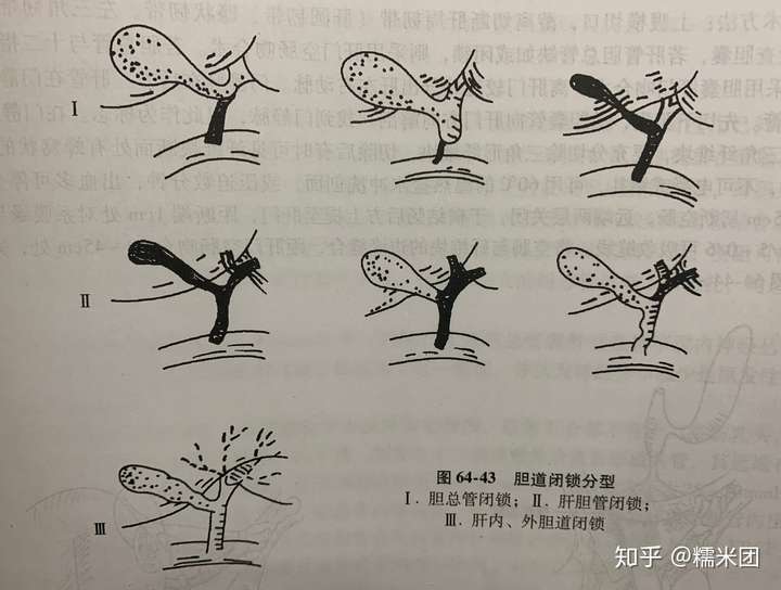 先天性胆道闭锁的传统解剖分类(图源:黄家驷外科学第7版)