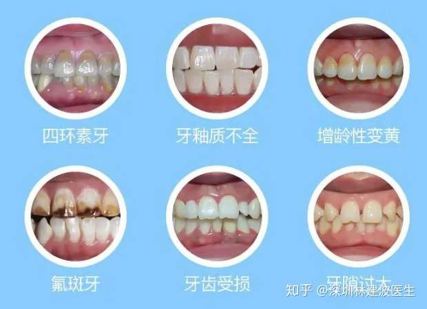 具体表现为: 1,形态异常牙,牙釉质发育不良,过小牙等.