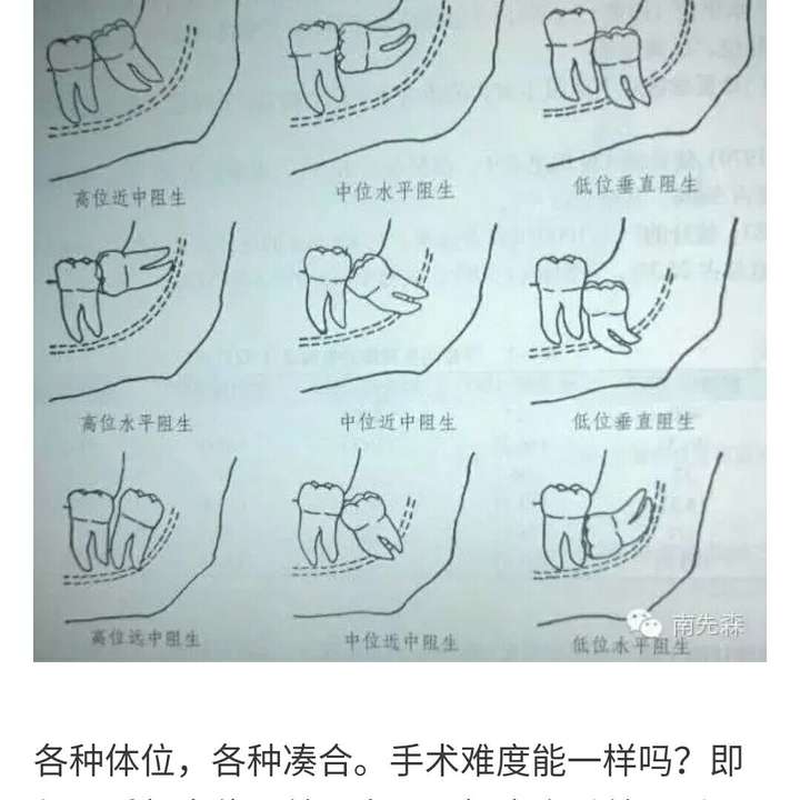 智齿一定要拔么?(有全片)?