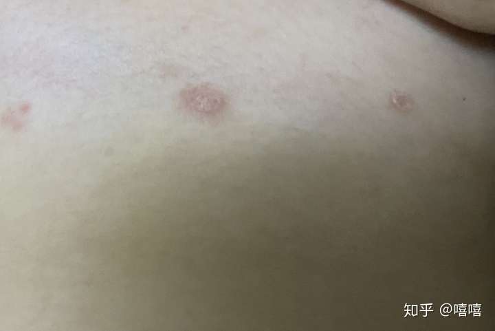 玫瑰糠疹过程记录