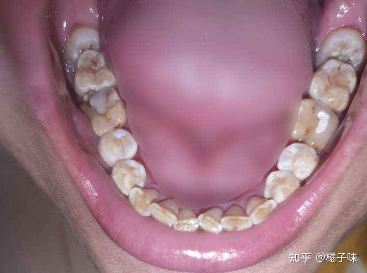 有图慎入, 99的牙齿,没一颗是好牙,明明已经每天刷牙,电动牙刷,漱口