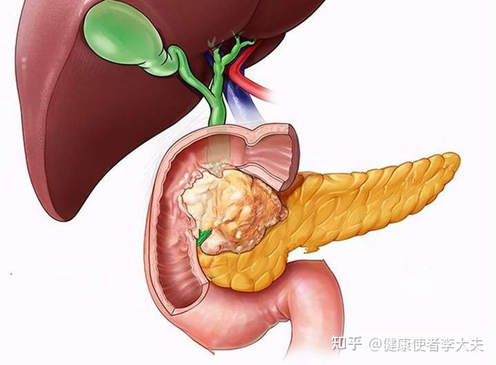 手术与随访过的两位胰头癌患者,有意思的是两位患者都是年龄相仿,胰腺