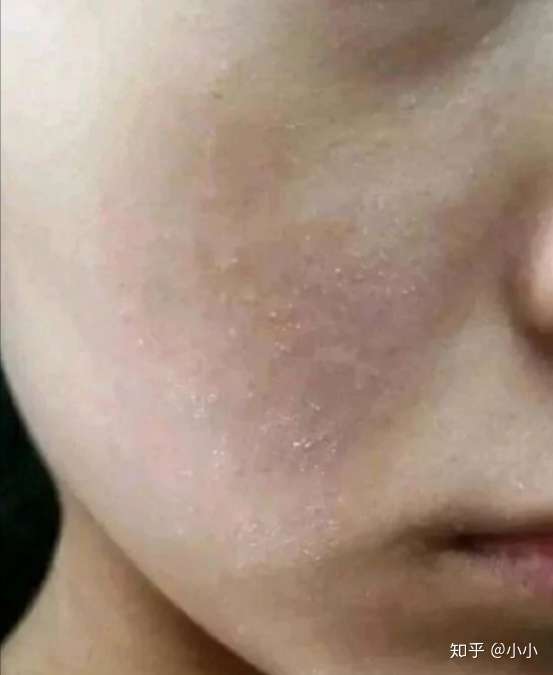 脸上皮肤干燥起皮怎么办?