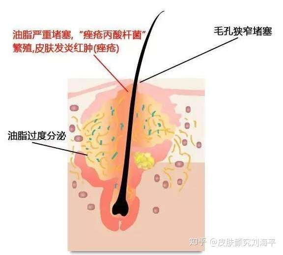 脂溢性皮炎