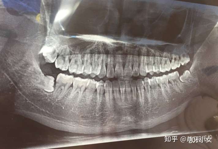 如果是低位阻生智齿的话,且在神经管上,恢复得会很慢.