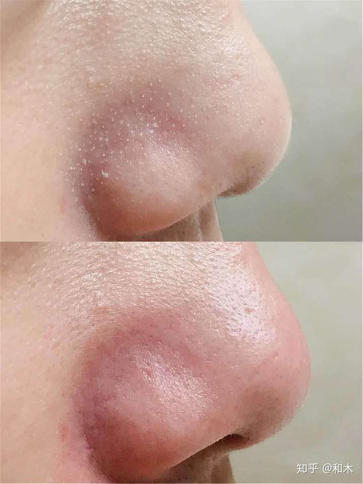 你们是怎么去黑头的?