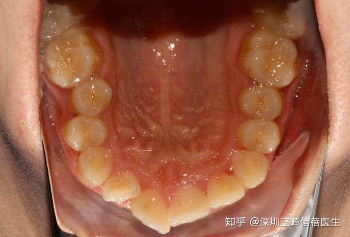 上颌牙列