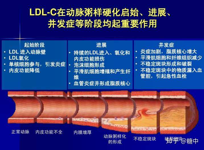 什么是动脉粥样硬化及动脉粥样化发生机制