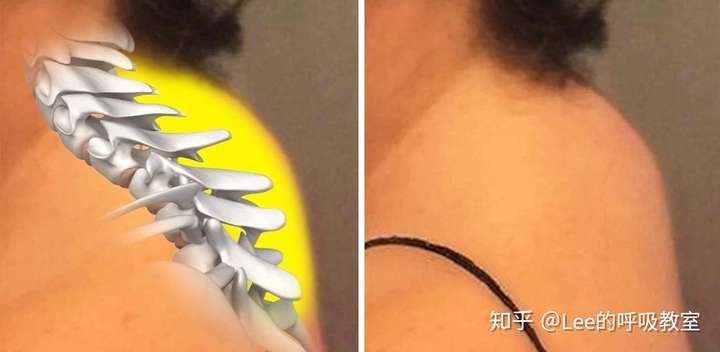 颈后大包长在哪,什么样?