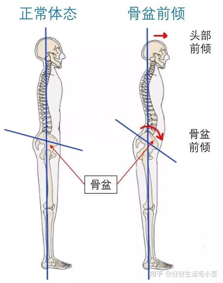 建议先找专业人士判断一下你有没有骨盆前倾,如果有,那么你的任务分为