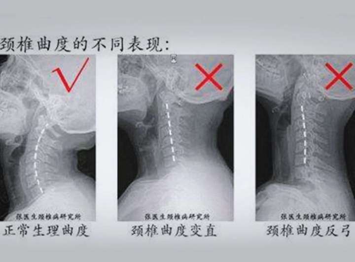 正常的颈椎曲度应该是这样的