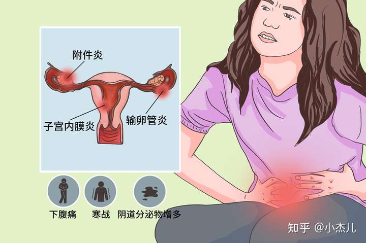 尤其衣原体感染常导致严重输卵管结构及功能破坏,并引起盆腔广泛粘连