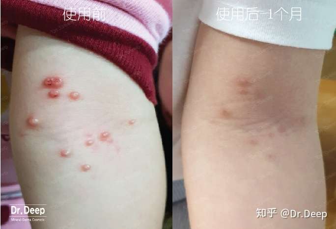 一岁宝宝传染性软疣如何治疗?