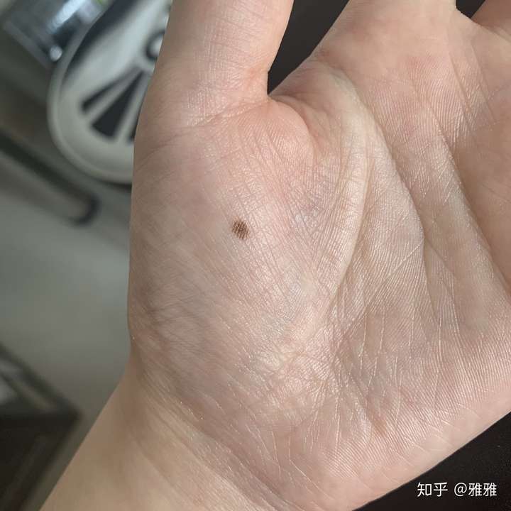 6年了,大夫说是色素痣,预约了下周去切, ,我还拿它当掌中宝呢