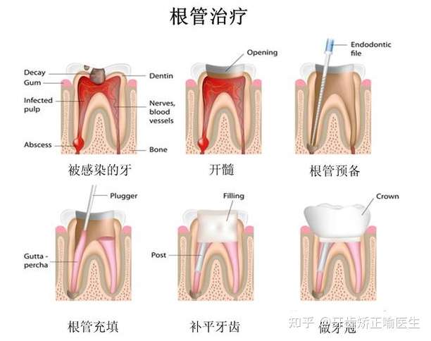 杀过神经的牙齿掉了一块可以不管吗?