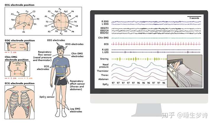 psg(多导睡眠监测设备)是监测睡眠及睡眠疾病的金标准,现在在一些大的