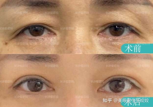 案例2:老化眼睑,皮肤松弛,看起来像单眼皮,实则内双眼,上睑下垂.