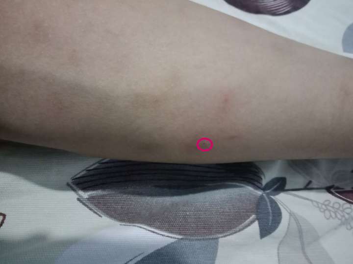 怎样区分过敏和蚊虫叮咬(以前出现过一次过敏性皮炎)?