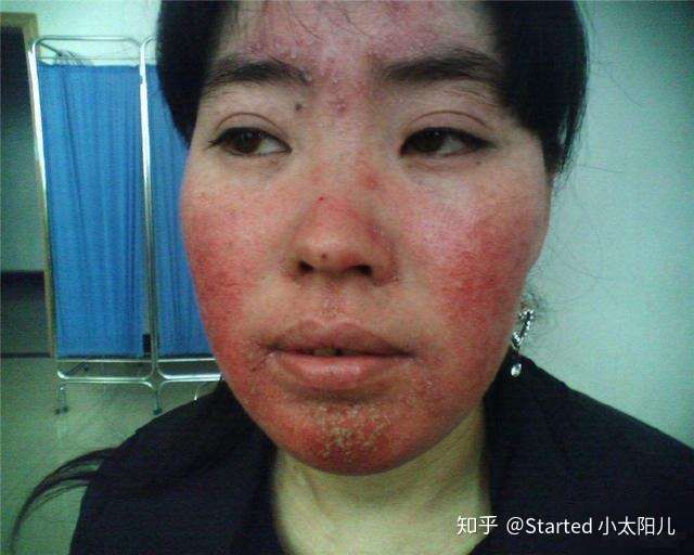 所以要对自己负责,烂脸之后的修复过程及漫长又痛苦.