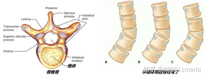 左:正常人类椎骨,右:半椎体的影响;图源musculoskeletal key