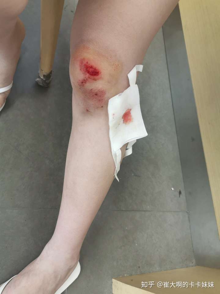骑车侧翻膝盖摔伤破皮,怎么处理伤口,怎样才能不留疤?