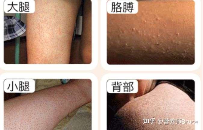 维a酸可以改善鸡皮肤吗?