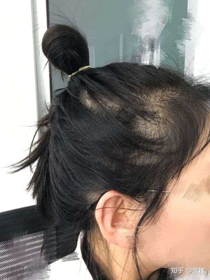 女生17头发少,已经露头皮秃顶,怎么办求方法?