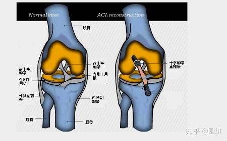 左膝外侧半月板撕裂前交叉韧带断裂受伤经过及康复之路