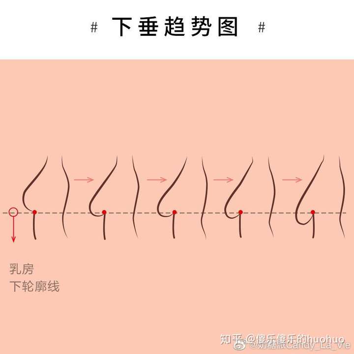 胸下垂的青春期女孩适不适合穿软钢圈内衣?